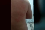 Elazığ’da böcek ısırığı hastanelik etti