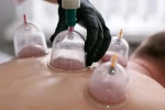 Hacamat uygulamasında hekim kontrolü ve steril ortamda yapılmalı