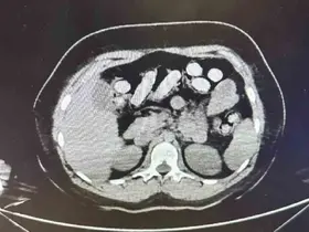 1.5 kilo metamfetamin iki kadın kuryenin bağırsak ve midesinden çıktı
