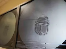Geçmeyen ağrılara OMÜ’de umut: Hastalar ağrı piliyle yeniden hayata tutunuyor
