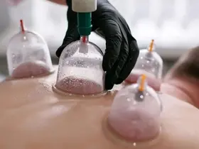 Hacamat uygulamasında hekim kontrolü ve steril ortamda yapılmalı
