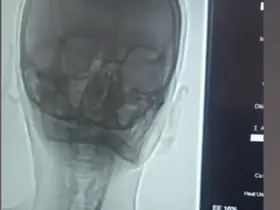 Iğdır’da şah damarı darlığına stentli müdahale
