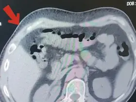 Mide ve bağırsaklarından 608 gram metamfetamin çıktı
