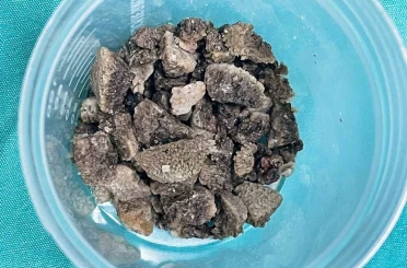 8 santimetrelik ’geyik boynuzu’ böbrek taşı kapalı yöntemle çıkarıldı 