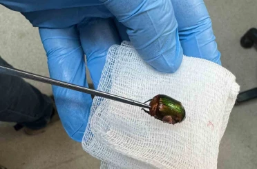 Ağrı ve işitme kaybı nedeniyle hastaneye gitti, kulağından Japon böceği çıktı 