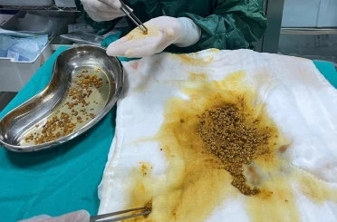Bingöl’de nadir vaka: Safra kesesinden 2 bin 67 taş çıkarıldı 