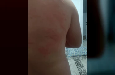 Elazığ’da böcek ısırığı hastanelik etti 