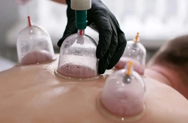 Hacamat uygulamasında hekim kontrolü ve steril ortamda yapılmalı 