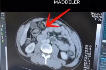 Mideye gizlenen uyuşturucu Erzincan’da ele geçirildi 