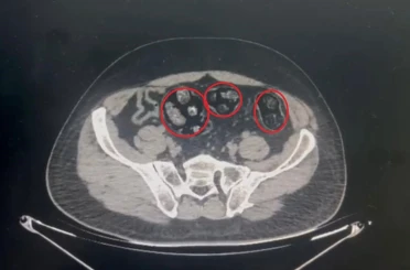 Yolcunun midesinden 62 parça uyuşturucu çıktı 