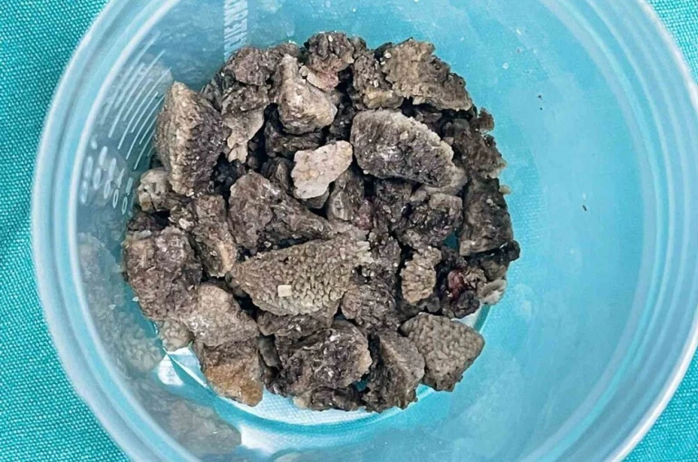 8 santimetrelik ’geyik boynuzu’ böbrek taşı kapalı yöntemle çıkarıldı
