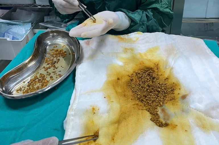 Bingöl’de nadir vaka: Safra kesesinden 2 bin 67 taş çıkarıldı