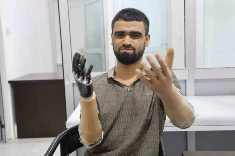 Demirin elektrik tellerine değmesiyle hayatı kararan Muhammed, 3 milyon TL değerindeki protez bacağına ve 2 biyonik koluna kavuştu