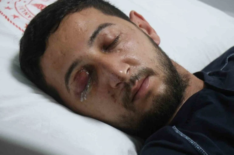 Düğün eğlencesi kabusa döndü: Sağ gözünden oldu