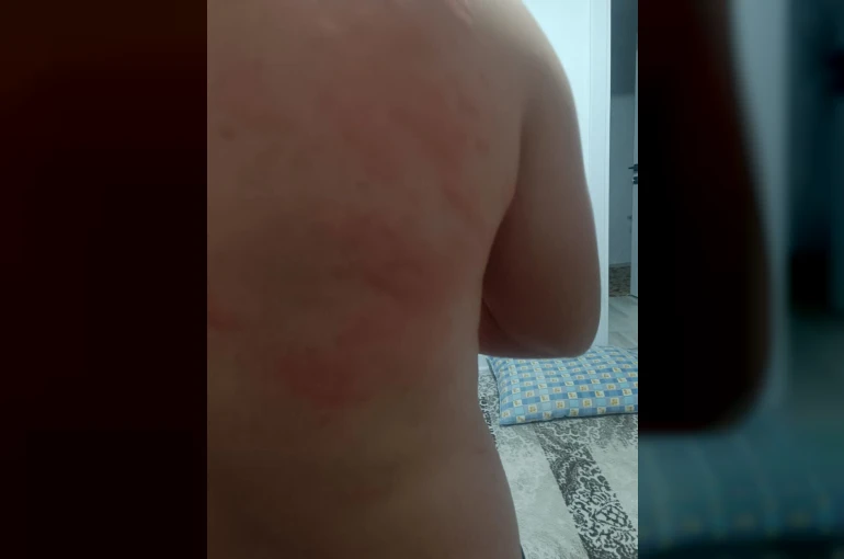Elazığ’da böcek ısırığı hastanelik etti